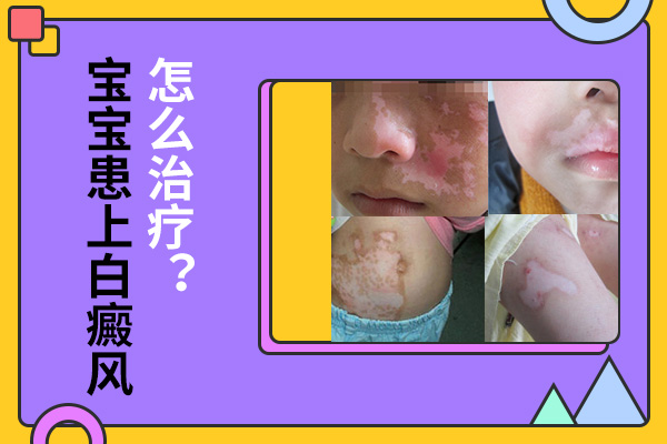 儿童应该怎么治疗白癜风才会对病情产生帮助?